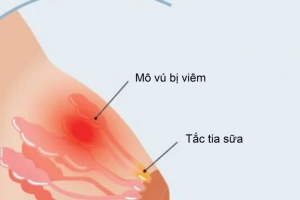Cách điều trị tắc tia sữa