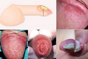 Cách dùng thuốc bôi viêm bao quy đầu