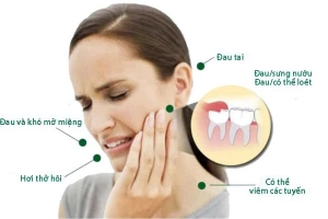 Cách giảm đau khi mọc răng khôn