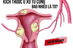 Cách giảm kích thước u xơ tử cung