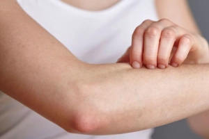 Cách giảm ngứa khi phát ban sốt xuất huyết