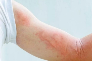 Cách kiểm soát cơn ngứa do mề đay tự phát mãn tính