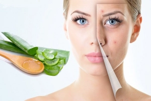 Cách làm mặt nạ nha đam trị mụn