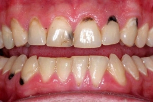 Cách loại bỏ đốm đen ở răng