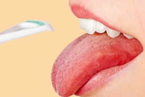 Cách trị lưỡi trắng ở người lớn