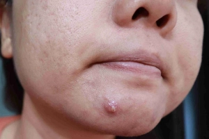Cách trị mụn bọc sưng đỏ tại nhà an toàn