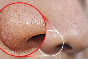 Cách trị mụn đầu đen ở mũi hiệu quả tại nhà