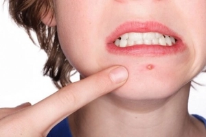Cách trị mụn đầu đinh dân gian