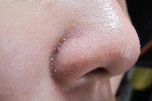 Cách trị mụn đầu trắng hiệu quả