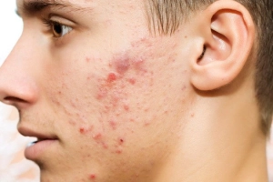 Cách trị mụn nội tiết ở nam giới