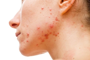 Cách trị mụn nội tiết sau sinh