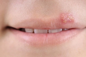 Cách trị mụn ở mép môi hiệu quả
