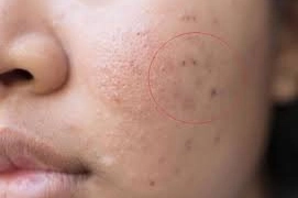 Cách trị mụn thâm cho da dầu