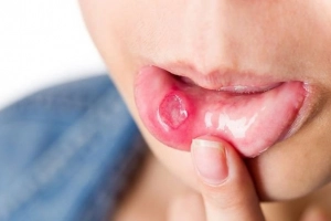 Cách trị nhiệt miệng nhanh khỏi, an toàn