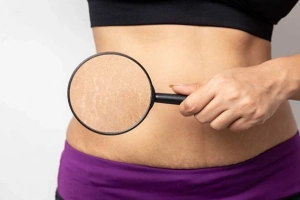 Cách trị rạn da trắng, đỏ khi tăng cân