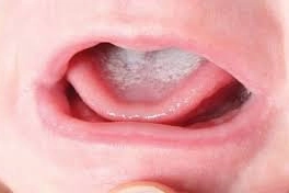 Cách trị trắng lưỡi ở trẻ sơ sinh hiệu quả