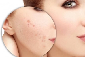 Cách tự nhiên giúp loại bỏ sẹo mụn