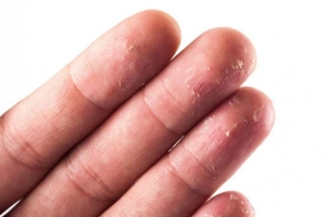 Cách xử lý khi bị tróc da tay