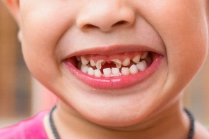 Cách xử lý khi răng sữa của trẻ bị mòn, mủn