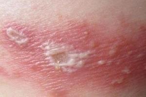 Cảm giác ngứa sau điều trị khỏi Zona thần kinh là sao?