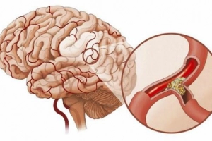 Cận lâm sàng và điều trị huyết khối tĩnh mạch não