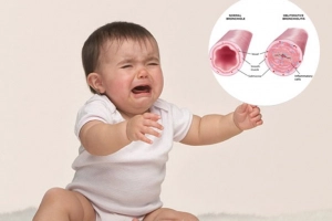 Cẩn trọng trẻ bị viêm tiểu phế quản bội nhiễm