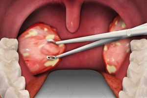 Cảnh giác biến chứng nhiễm trùng sau cắt amidan