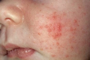 Cảnh giác các loại mụn ở trẻ sơ sinh