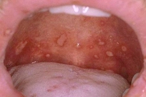 Cảnh giác loét miệng trong tay chân miệng ở trẻ
