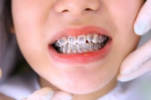 Cảnh giác sâu răng khi niềng răng