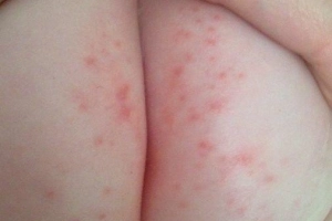 Cảnh giác trẻ bị hăm da do tiêu chảy