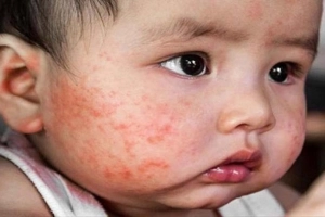 Cảnh giác viêm da cơ địa ở trẻ em khi giao mùa