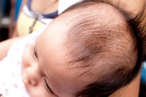Cảnh giác viêm da đầu ở trẻ bị viêm da cơ địa