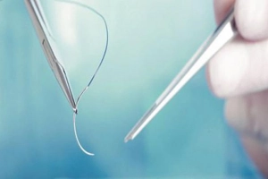 Cắt chỉ vết thương sau mổ đẻ còn sót, phải làm thế nào?