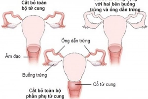 Cắt tử cung hoàn toàn khiến cơ thể bạn thay đổi thế nào?