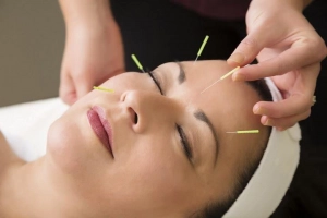 Châm cứu trên khuôn mặt là gì?