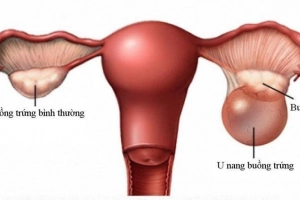 Chăm sóc bệnh nhân sau mổ u nang buồng trứng
