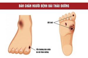 Chăm sóc ngón chân bị hoại tử ở người bị tiểu đường