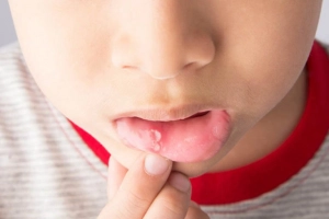 Chăm sóc trẻ bị viêm niêm mạc miệng
