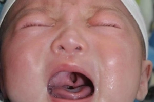 Chăm sóc và điều trị cho trẻ sơ sinh bị hở vòm họng