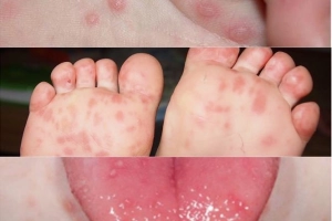 Chẩn đoán sớm bệnh tay chân miệng