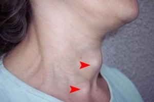 Chẩn đoán tình trạng mắc bệnh Basedow như thế nào?