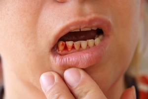 Chảy máu chân răng uống thuốc gì?