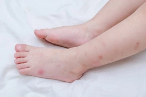 Chảy máu khi bị sốt xuất huyết: Dấu hiệu cảnh báo giảm tiểu cầu