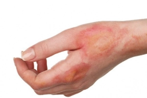 Chảy mủ chỗ ghép da do bỏng sau 3 tuần có sao không?
