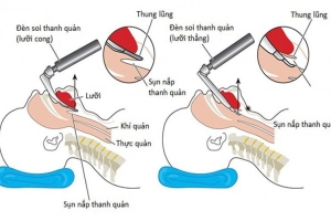 Chỉ định gây mê đặt nội khí quản được áp dụng trong trường hợp nào?
