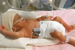 Chỉ định thở CPAP cho trẻ bị suy hô hấp