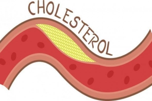 Chỉ số cholesterol tăng nhẹ nên làm gì?