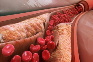 Chỉ số cholesterol toàn phần thấp có sao không?