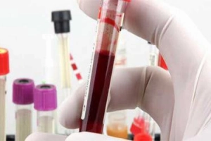 Chỉ số HBV DNA 80,000/ml có ý nghĩa gì?